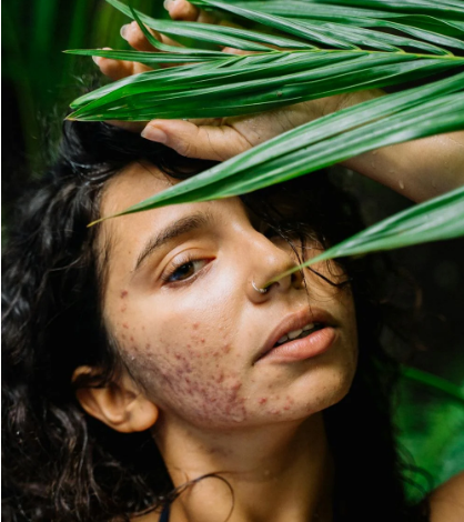 Fresh & Dewy: Water-Based Serums to Keep Skin Calm in Humidity
